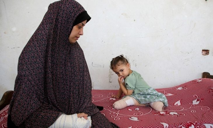 مبتورو الأطراف في غزة يكافحون لإعادة بناء حياتهم في غياب الأطراف الاصطناعية